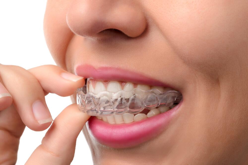 Invisalign-treatment