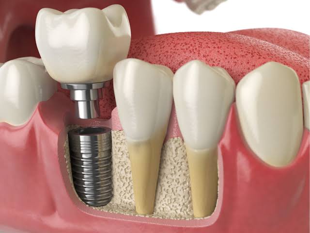 Dental Implants in Redlands