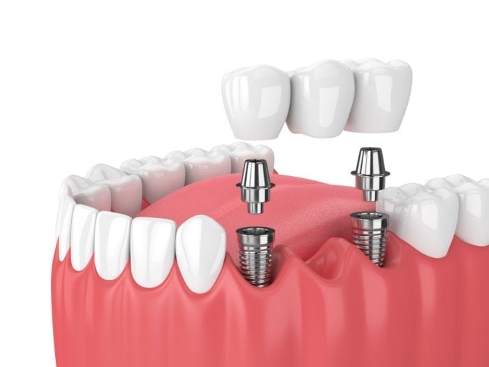 Implant Supported Denture in Redlands
