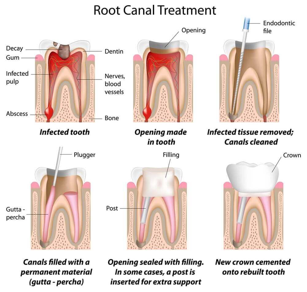 Root Canal Treatment in Redlands